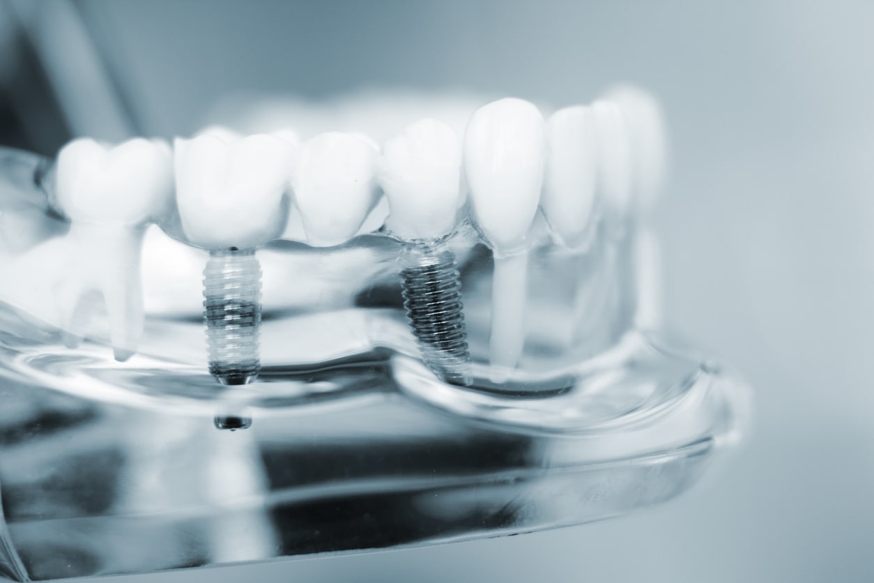 dental implants in transparent model jaw